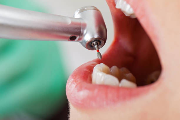 Best Broken or Chipped Tooth Repair in Mariposa, CA